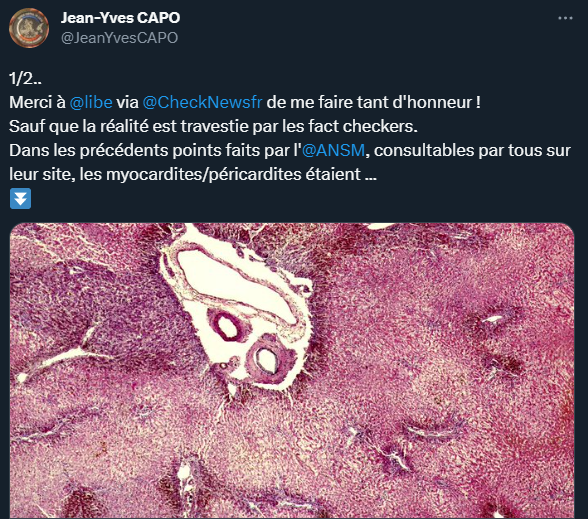 Etude de cas d&rsquo;une tentative de &laquo;&nbsp;rechecking&nbsp;&raquo; : l&rsquo;ANSM et la reconnaissance des&nbsp;myocardites